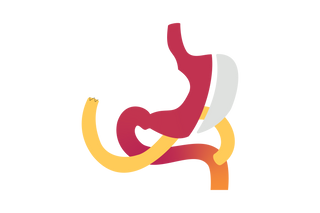 Duodenal Switch (DS / SADI)