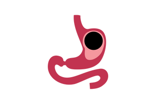 Intragastric Balloon (IGB)