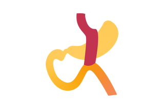 Mini Gastric Bypass (OAGB)